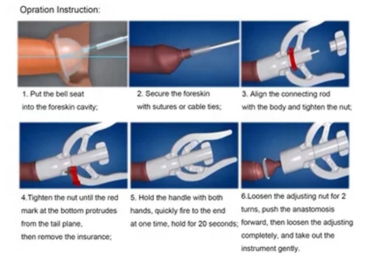 Suture skin Circumcision Suture skin Circumcision